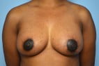 Breast Lift with Augmentation