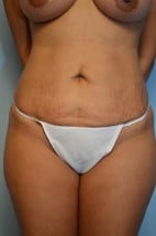 Liposuction Trunk