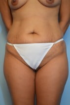 Liposuction Trunk