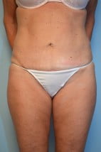 Liposuction with Mini Tummy Tuck