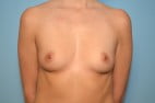 Breast Augmentation