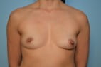 Breast Augmentation