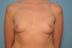 Breast Augmentation