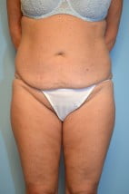Liposuction with Mini Tummy Tuck