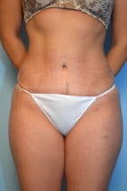 Abdominoplasty + lipo