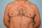 Gynecomastia