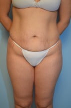 Abdominoplasty + lipo