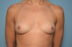 Breast Augmentation