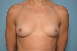 Breast Augmentation