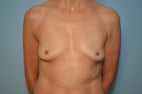 Breast Implant Removal