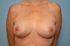 Pectus Carinatum and Breast Asymmetry