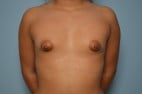 Tubular Breast Correction