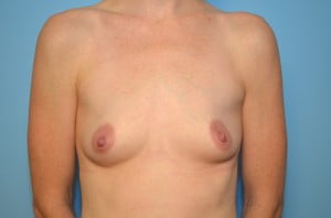 Breast Augmentation