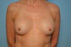 Breast Implant Removal