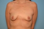 Pectus Carinatum and Breast Asymmetry