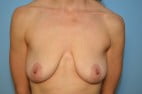 Breast Augmentation with Breast Lift