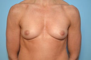 Breast Augmentation