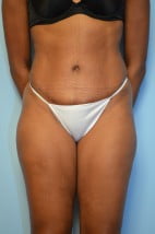 Abdominoplasty