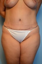 Abdominoplasty