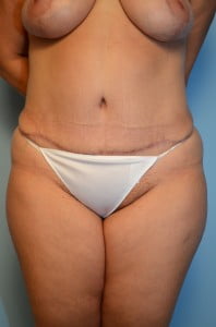 Abdominoplasty