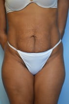 Abdominoplasty