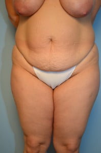 Abdominoplasty