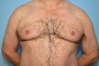 Gynecomastia