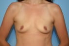 Breast Augmentation