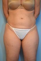 liposuction