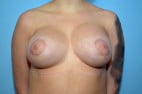 Tubular Breast