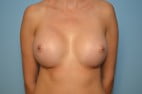 Breast Augmentation