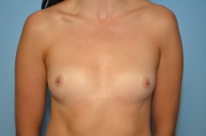 Breast Augmentation