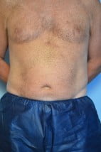 Liposuction