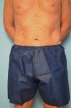 Liposuction