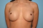 Removal and Replace Breast Implants