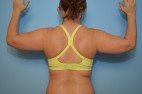 Liposuction Arms, Abdomen and Flanks