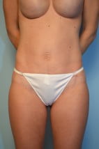 Umbilical Float Tummy Tuck