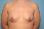 Breast Augmentation