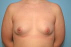 Breast Augmentation