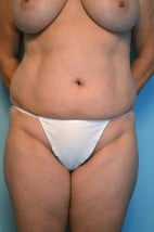 Liposuction Abdomen and Flanks