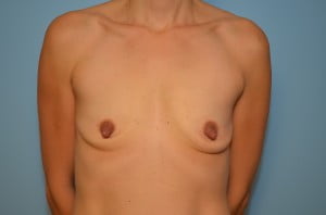 Breast Augmentation