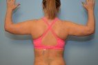 Liposuction Arms, Abdomen and Flanks