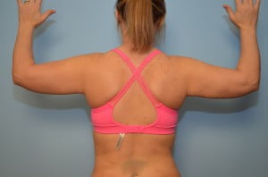 Liposuction Arms, Abdomen and Flanks
