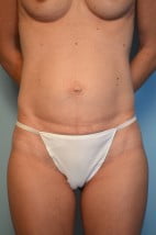 Umbilical Float Tummy Tuck