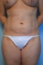 Liposuction Abdomen and Flanks