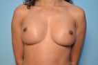 Removal and Replace Breast Implants