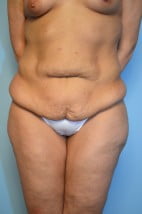 Abdominoplasty