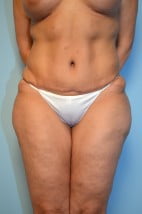 Abdominoplasty