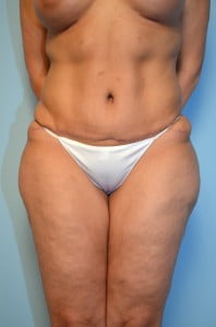 Abdominoplasty