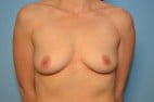 Breast Augmentation